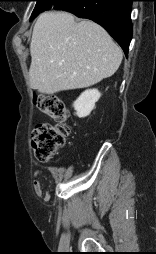 Calcified adrenal glands and Spigelian hernia (Radiopaedia 49741-54988 C 132).jpg