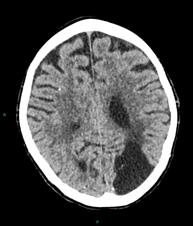 Calcified cerebral emboli from left ventricular thrombus (Radiopaedia 84420-99758 Axial non-contrast 34).jpg