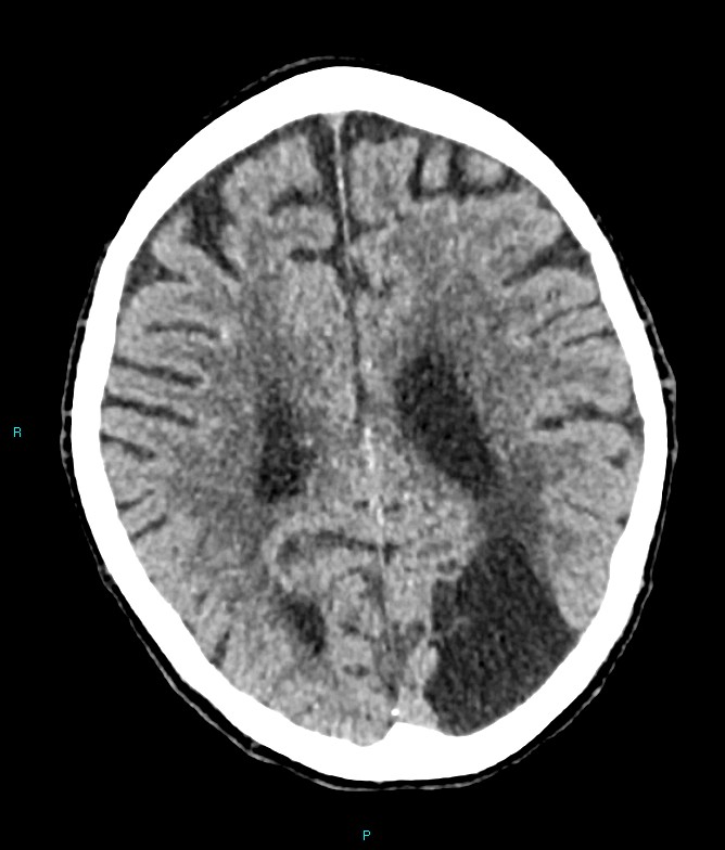 Calcified cerebral emboli from left ventricular thrombus (Radiopaedia 84420-99758 Axial non-contrast 35).jpg