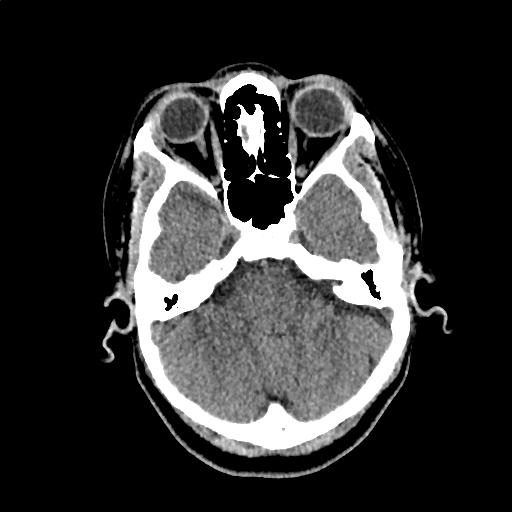 Calcified cerebral hydatid cyst (Radiopaedia 65603-74717 Axial non-contrast 11).jpg