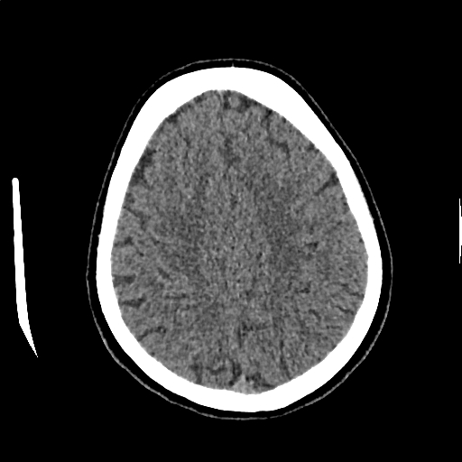 Calcified cerebral hydatid cyst (Radiopaedia 65603-74717 Axial non-contrast 57).jpg