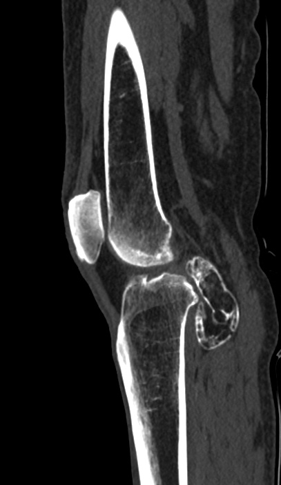 Calcified hematoma - popliteal fossa (Radiopaedia 63938-72763 Sagittal bone window 55).jpg