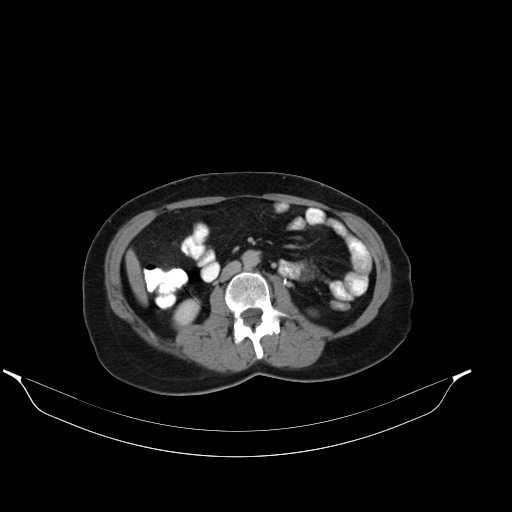File:Calcified hydatid cyst of the liver (Radiopaedia 21212-21112 Axial C+ delayed 28).jpg