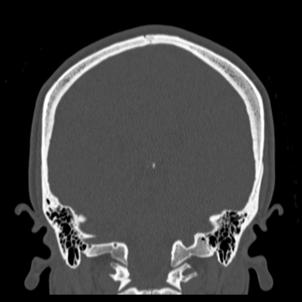 Calvarial osteoma (Radiopaedia 36520-38079 C 62).jpg