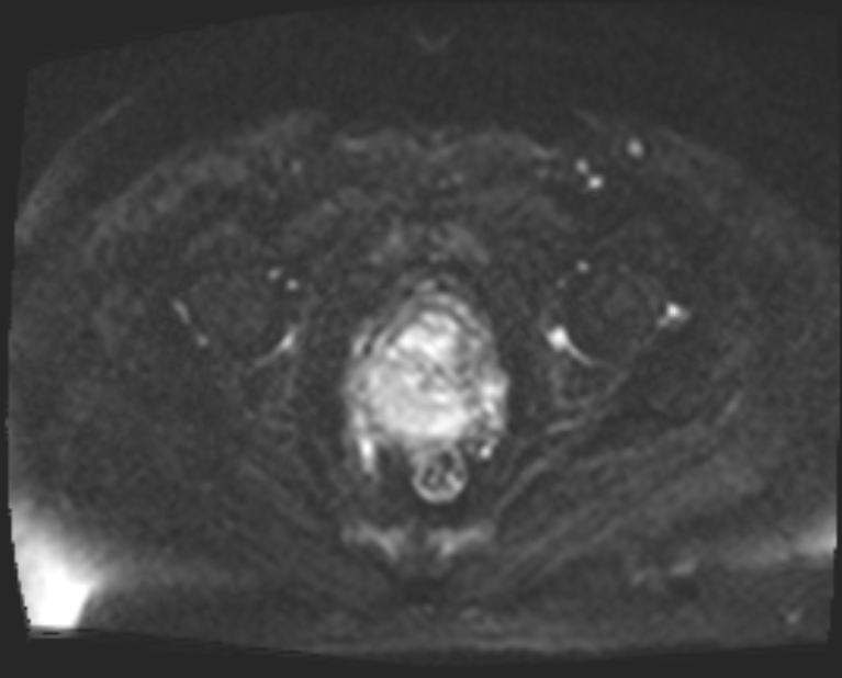 Cancer cervix - stage IIb (Radiopaedia 75411-86615 Axial DWI 37).jpg