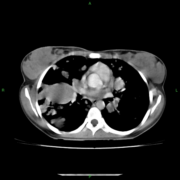 File:Cannon ball metastases - synovial sarcoma (Radiopaedia 26135-26271 C 18).jpg