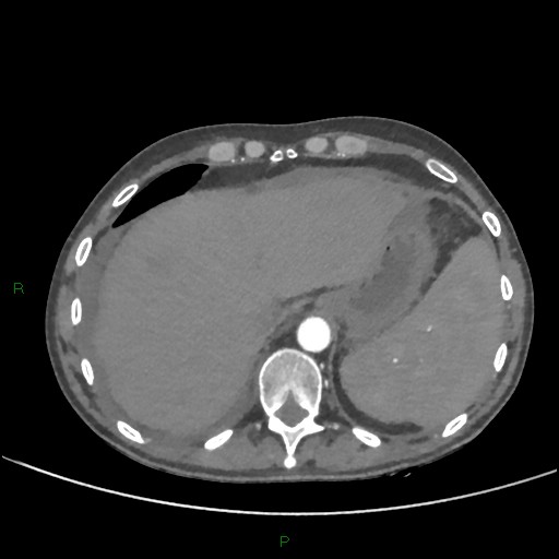 File:Cannonball metastases (Radiopaedia 82110-96150 Axial C+ CTPA 279).jpg