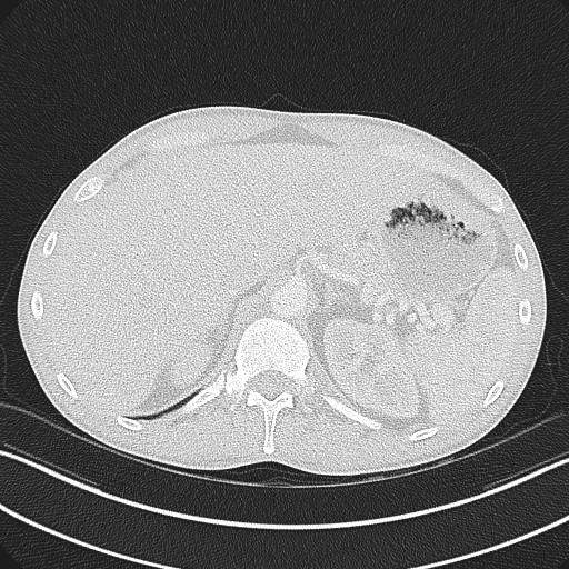 Cannonball metastases - testicular choriocarcinoma (Radiopaedia 84510-99891 Axial lung window 92).jpg