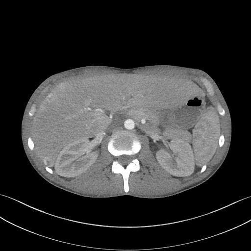 File:Cannonball metastases - testicular choriocarcinoma (Radiopaedia 84510-99891 B 116).jpg