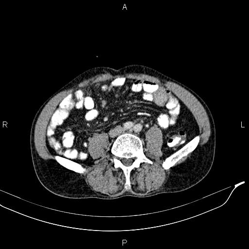 Caput medusae sign - portal hypertension (Radiopaedia 64007-72759 A 60).jpg