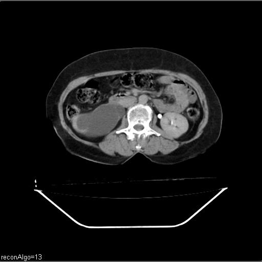File:Carcinoma cervix- recurrence (Radiopaedia 34702-36137 Axial C+ delayed 13).jpg