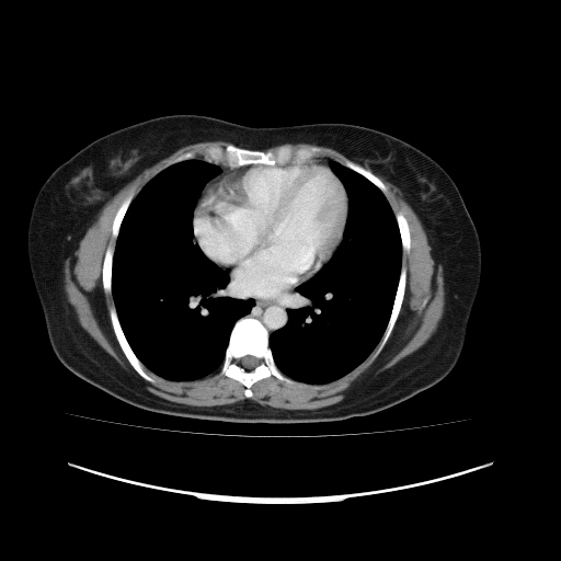 Carcinoma colon - hepatic flexure (Radiopaedia 19461-19493 A 1).jpg