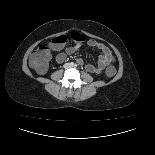 Carcinoma colon - hepatic flexure (Radiopaedia 19461-19493 A 74).jpg