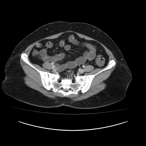 File:Carcinoma colon - hepatic flexure (Radiopaedia 19461-19493 A 97).jpg