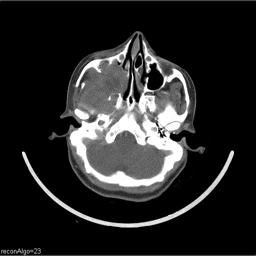 Carcinoma of the maxillary antrum (Radiopaedia 53805-59888 Axial C+ delayed 57).jpg