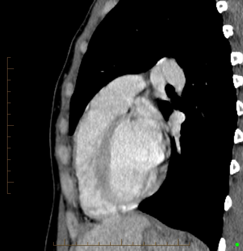 Cardiac paraganglioma (Radiopaedia 76345-88005 C 34).jpg