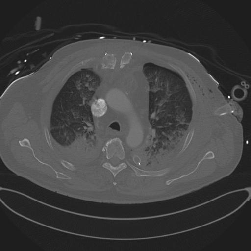 File:Cardiac trauma (Radiopaedia 32874-33858 Axial bone window 29).jpg