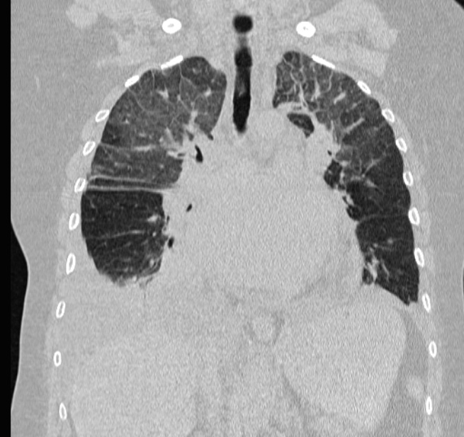 Cardiogenic pulmonary edema (Radiopaedia 29213-29609 Coronal lung window 34).jpg