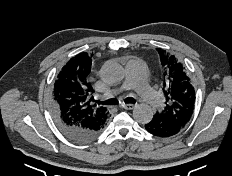Cardiogenic pulmonary edema (Radiopaedia 68180-77678 Axial non-contrast 17).jpg