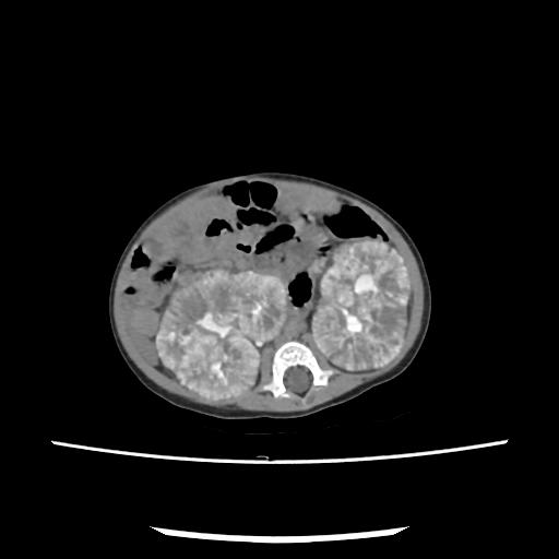 Caroli disease with autosomal recessive polycystic kidney disease (ARPKD) (Radiopaedia 89651-106703 E 129).jpg
