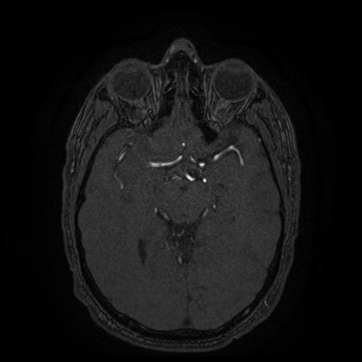 Carotid arterial dissection with acute cerebral infarction (Radiopaedia 26636-26784 MRA 93).jpg