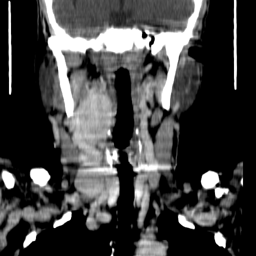 File:Carotid body tumor (Radiopaedia 27890-28124 B 10).jpg