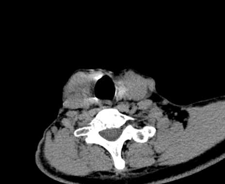 Carotid body tumor (Radiopaedia 61750-69757 Axial non-contrast 89).jpg