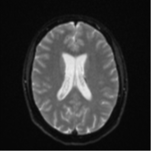 File:Cavernoma with bleed - midbrain (Radiopaedia 54546-60774 Axial DWI 16).png
