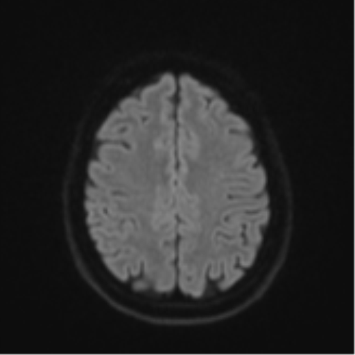 File:Cavernoma with bleed - midbrain (Radiopaedia 54546-60774 Axial DWI 48).png