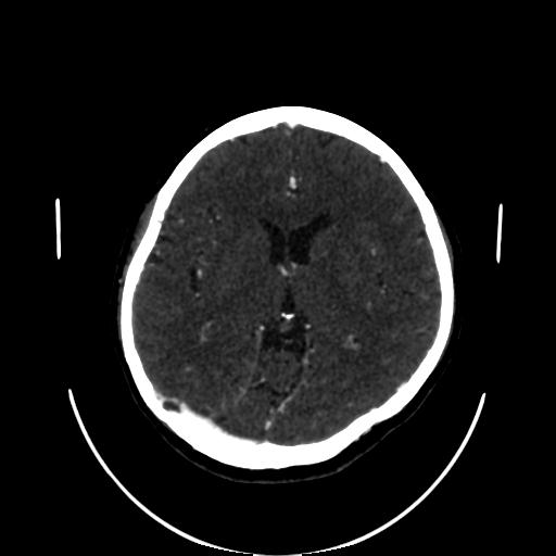 Cavernoma with developmental venous anomaly (Radiopaedia 22470-22506 C 88).jpg