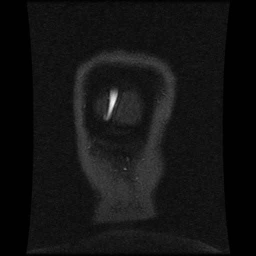 Cavernoma with developmental venous anomaly (Radiopaedia 22470-22507 MRV 24).jpg