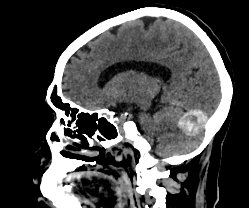 Cavernous hemangioma of the cerebellar falx (Radiopaedia 73025-83723 B 193).jpg