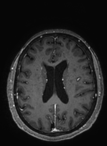 Cavernous hemangioma of the cerebellar falx (Radiopaedia 73025-83724 Axial T1 C+ 128).jpg
