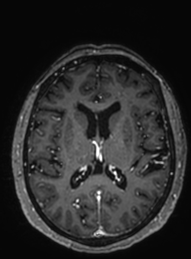 File:Cavernous hemangioma of the cerebellar falx (Radiopaedia 73025-83724 Axial T1 C+ 148).jpg
