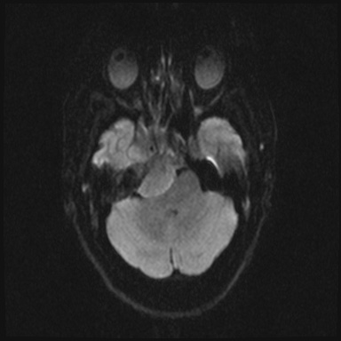 Cavernous sinus meningioma (Radiopaedia 63682-72367 DWI 27).jpg