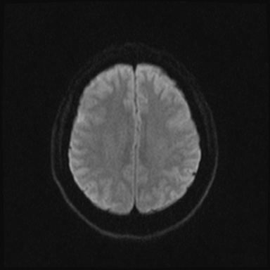 Cavernous sinus meningioma (Radiopaedia 63682-72367 DWI 36).jpg
