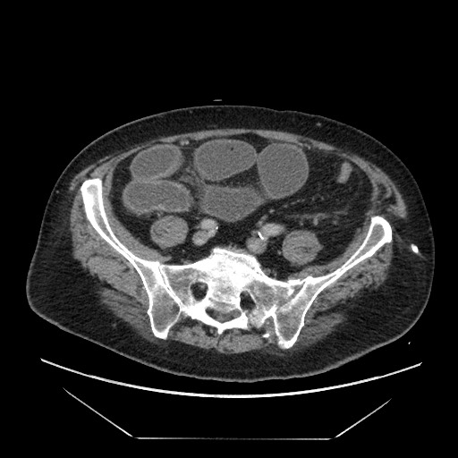 Cecal adenocarcinoma (Radiopaedia 64871-73817 A 70).jpg