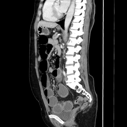 Cecal adenocarcinoma (Radiopaedia 75909-87331 C 42).jpg