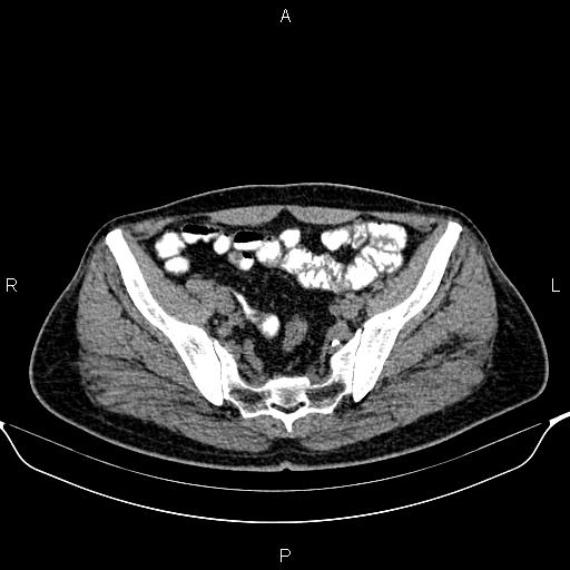 Cecal adenocarcinoma (Radiopaedia 85324-100916 Axial non-contrast 79).jpg