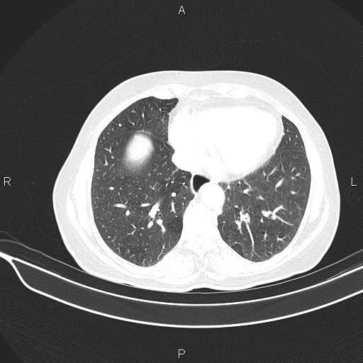 Cecal cancer (Radiopaedia 85610-101358 Axial lung window 47).jpg