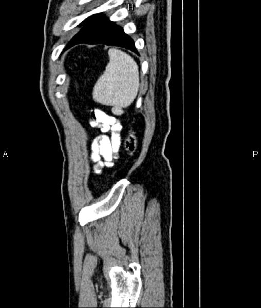 File:Cecal cancer with appendiceal mucocele (Radiopaedia 91080-108651 E 89).jpg