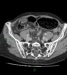 Cecal volvulus (Radiopaedia 86741-102900 A 97).jpg