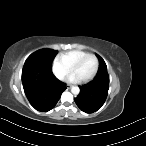 Cecum hernia through the foramen of Winslow (Radiopaedia 46634-51112 A 2).png