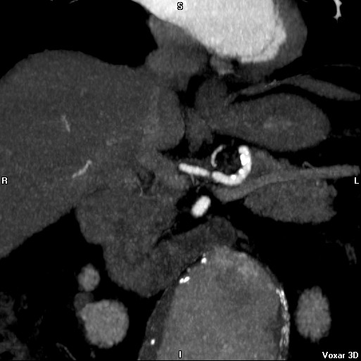 File:Celiac artery anatomy (Radiopaedia 16763-16476 A 9).jpg