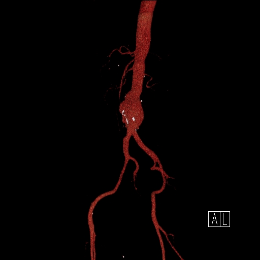 File:Celiac artery compression by the diaphragmatic crurae (Radiopaedia 31739-32666 3D CTA 17).jpg