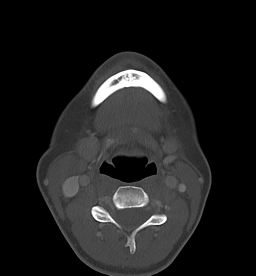 Cemento-ossifying fibroma (Radiopaedia 46243-50643 Axial bone window 49).png