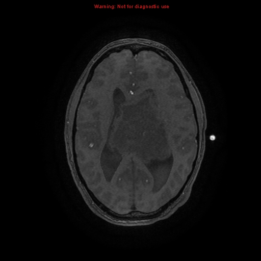 Central neurocytoma (Radiopaedia 13188-13206 Axial MRA 18).jpg