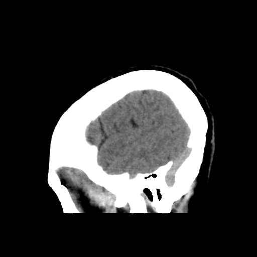 File:Central neurocytoma (Radiopaedia 65317-74346 C 45).png