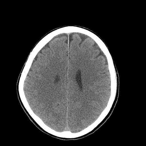 Central neurocytoma (Radiopaedia 68725-78432 Axial non-contrast 35).jpg