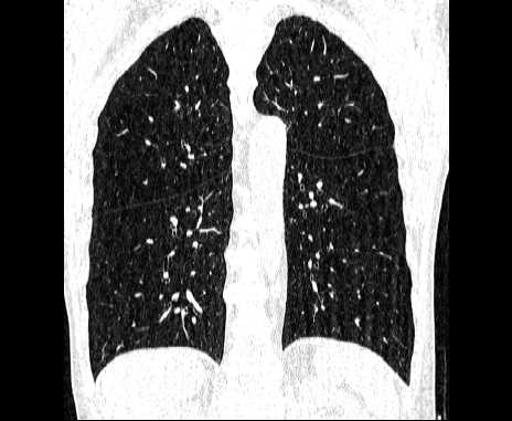 Centrilobular pulmonary emphysema (Radiopaedia 62468-70718 Coronal lung window 50).jpg